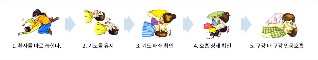 1 환자를 바로눕힌다 2 기도를 유지 3 기도 패쇄 확인 4 호흡 상태 확인 5 구강 대 구강 인공호흡